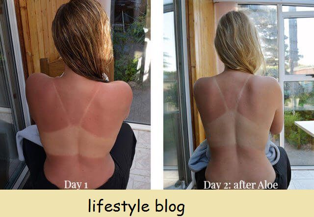 Como usar Aloe Vera para tratar queimaduras solares